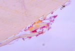 This photomicrograph depicts the histopathologic c