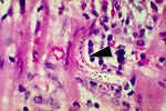 This micrograph reveals a Strongyloides stercorali