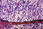 This photomicrograph reveals histopathologic chang