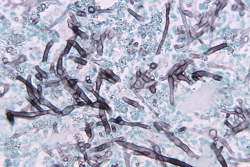 Under a magnification of 500X, this photomicrograph of a murine brain tissue sample revealed some of the histopathologic changes associated 