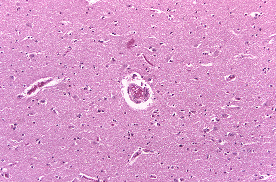 Under a relatively-low magnification of 125X, this photomicrograph of a brain tissue sample revealed some of the histopathologic changes ass