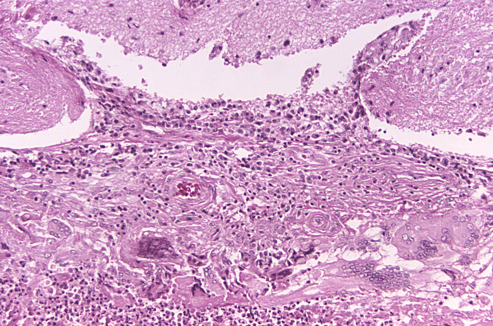 Under a relatively-low magnification of 125X, this photomicrograph of a brain tissue sample revealed some of the histopathologic changes ass