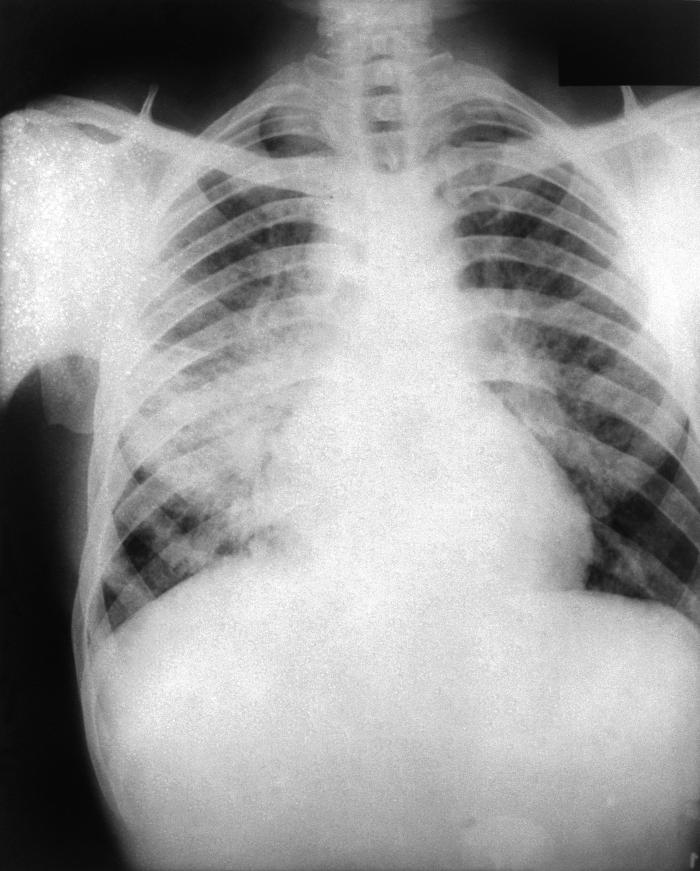 This 1961 plane film x-ray revealed an enlarged mediastinum, diffuse parenchymal nodularity with more significant involvement of the right l