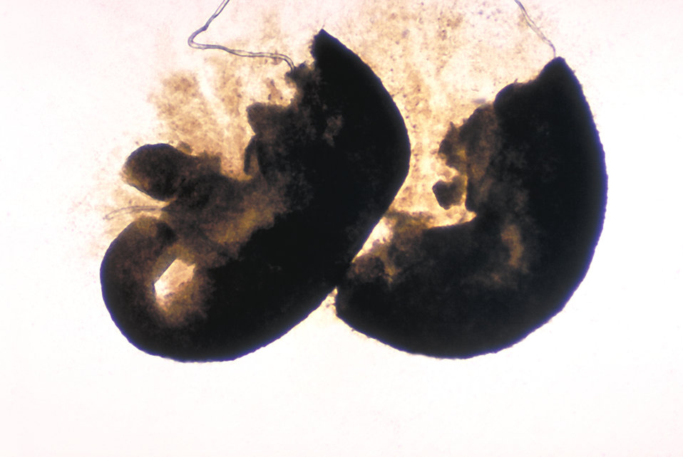 These are fresh granules of the fungus Madurella grisea processed on a KOH (potassium hydroxide) mount.