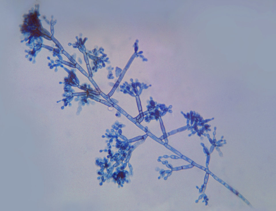 This is a photomicrograph of the dematiaceous, or dark colored fungi Fonsecaea pedrosoi.