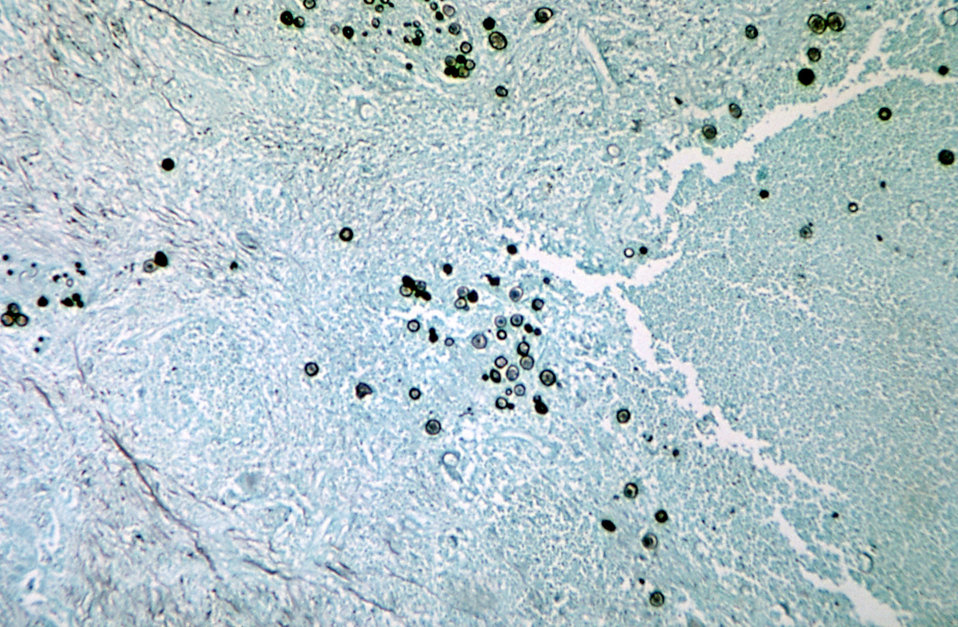 This methenamine silver stained photomicrograph reveals spherules of Coccidioides immitis fungus.