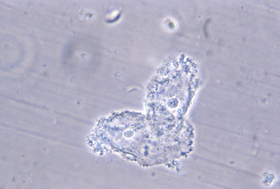 This photomicrograph reveals bacteria adhering to vaginal epithelial cells known as 'clue cells'.