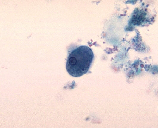 Entamoeba histolytica trophozoite with atypical nucleus.  Trichrome stain.