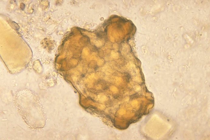 Infertile egg of Ascaris lumbricoides.