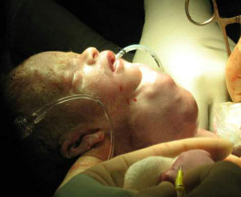 Wilford Hall doctors perform lifesaving procedure on newborn