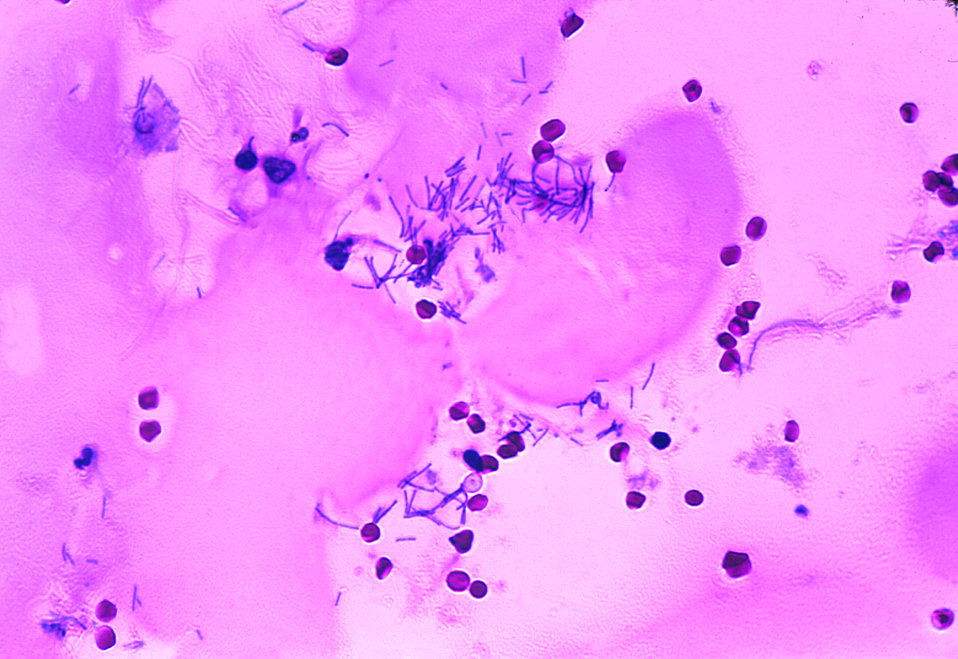 Human meningitis with the presence of Bacillus anthracis.