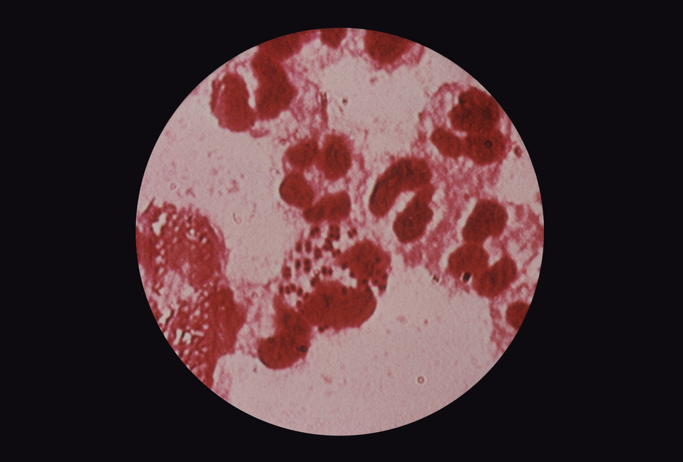 This is a photomicrograph of a urethral discharge specimen showing the Gram-negative diplococcus, Neisseria gonorrhoeae.