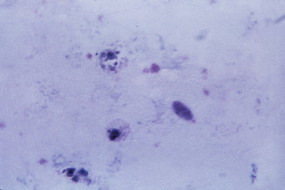 This thick film Giemsa stained micrograph shows an amoeboid, and a mature Plasmodium vivax trophozoite.