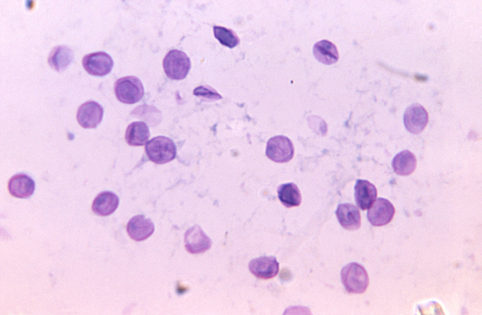 A photomicrographic image showing a concentration of Pneumocystis jirovecii, formerly known as Pneumocystis carinii fungi after a sonificati