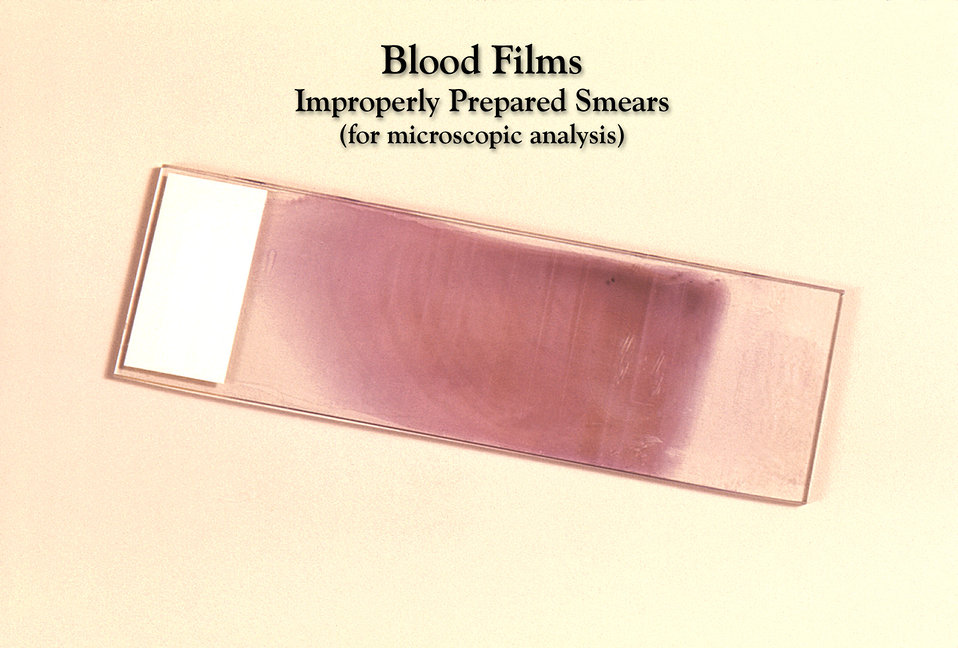 Poor film preparation technique yielded an unfavorable result in this Giemsa stained slide specimen.