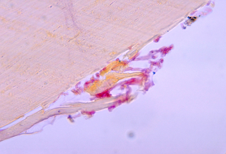 This photomicrograph depicts the histopathologic changes seen in onychomycosis due to a Fusarium sp. of fungus.