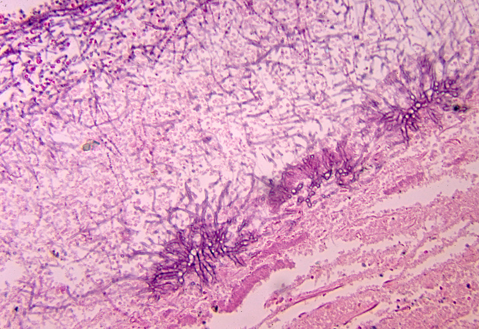 This micrograph depicts the histopathologic features of aspergillosis including the presence of fungal hyphae.