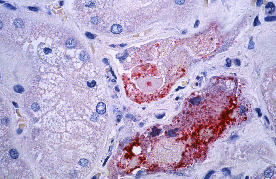 Using immunohistochemical (IHC) technique, this photomicrograph revealed some of the cytoarchitectural histopathologic changes associated wi