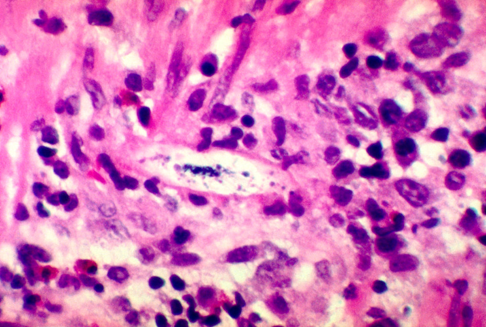 This micrograph depicts the histopathologic changes caused by Strongyloides stercoralis embedded in the intestinal wall.