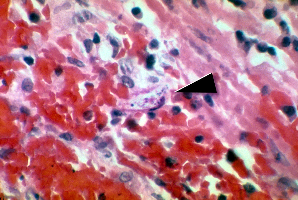 This micrograph reveals a Strongyloides stercoralis parasite embedded in the intestinal mucosa.