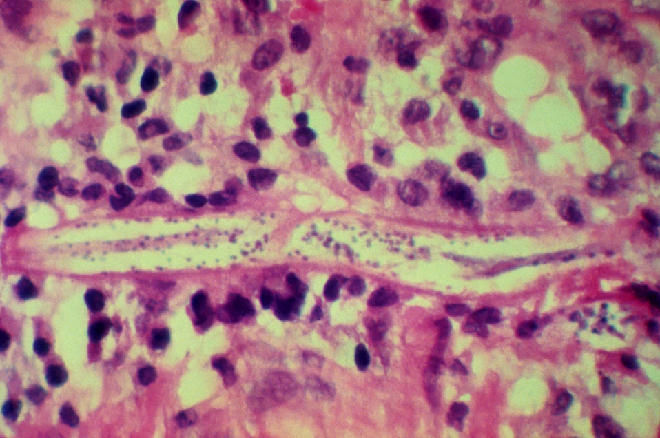 This micrograph reveals a Strongyloides stercoralis parasite embedded in the intestinal mucosa.