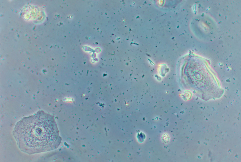 This photomicrograph of a vaginal smear identifies Candida albicans while using a wet mount technique.