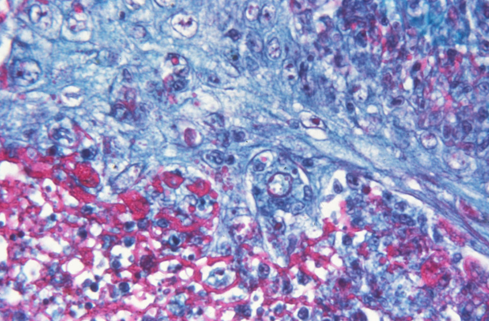 Public Domain Picture | This micrograph reveals the histologic changes ...